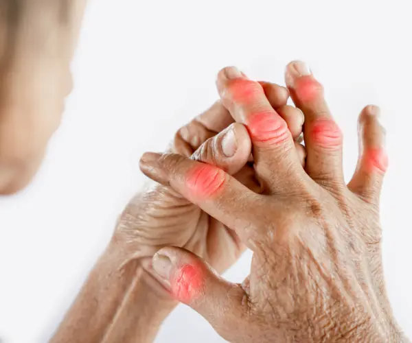 Arthritis Pain Treatment